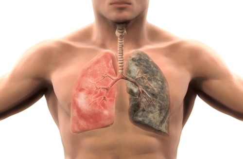 lung cancer