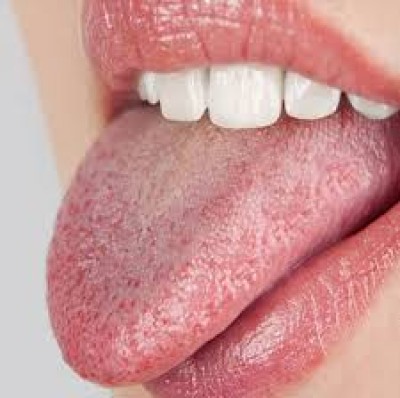 tongue cancer