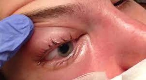 mucoramycosis is not an infectious disease!