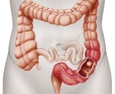 colorectal cancer