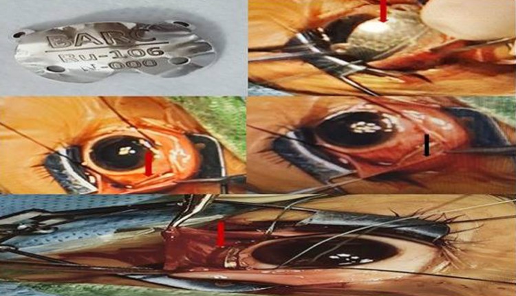 eye tumor treatment