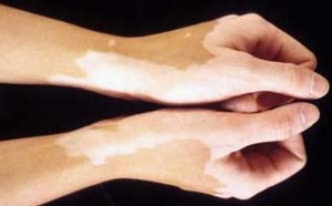 सफेद दाग-leucoderma