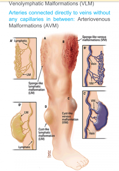 vascular malformations
